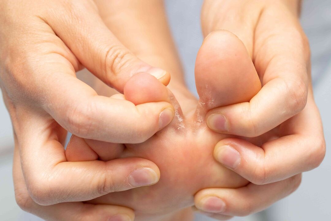 Fungus between the toes and the treatment with Demyxil cream