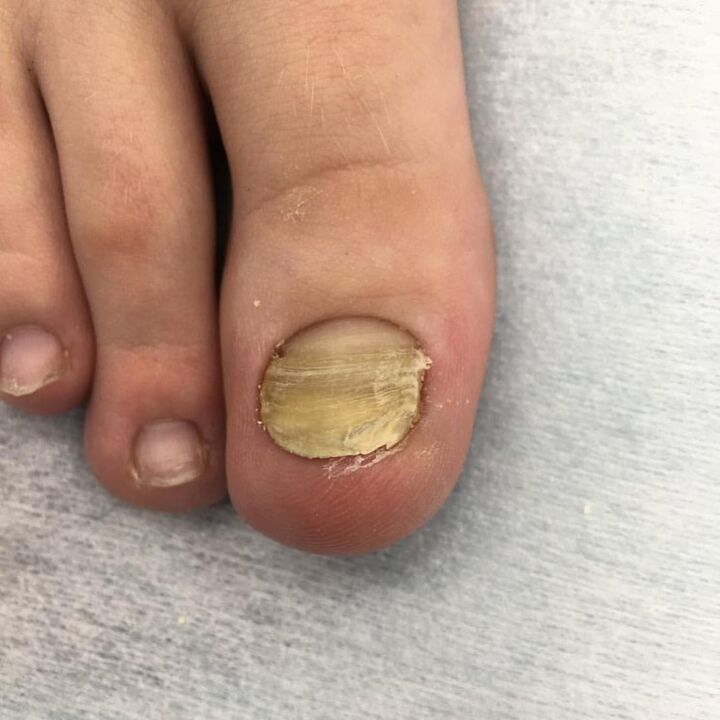 infection