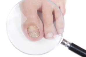 Causes of nail fungus
