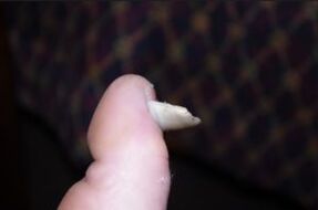 Symptoms of mushrooms on the nails