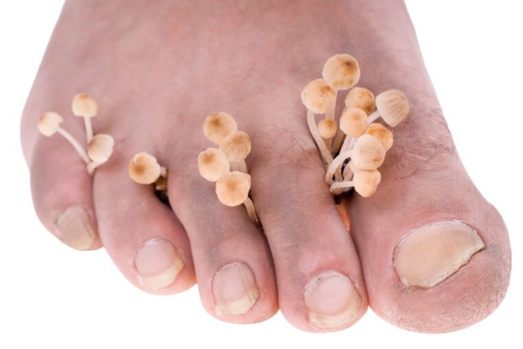 fungus on the symptoms of legs