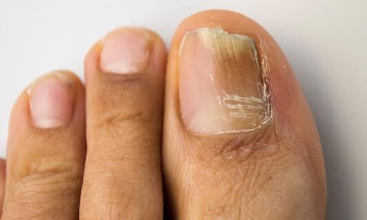 Distal-legeral type of injuries with onychomycosis on the legs