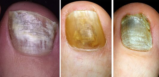In the picture to change the color of fungal nails