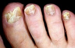 symptoms of nail fungus