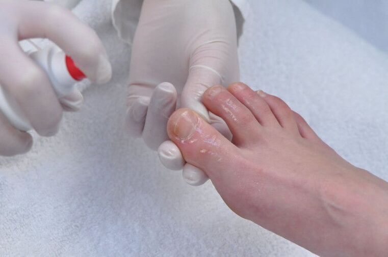 treatment of the nail plate due to fungal infection